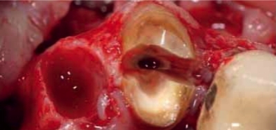 Root Sectioning Kit Samarani 2